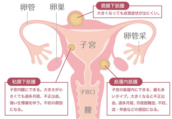 閉経 前 の 子宮 筋腫