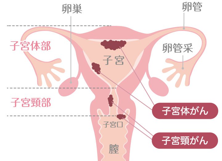 子宮がんについて