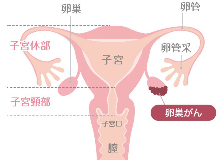 卵巣がんについて