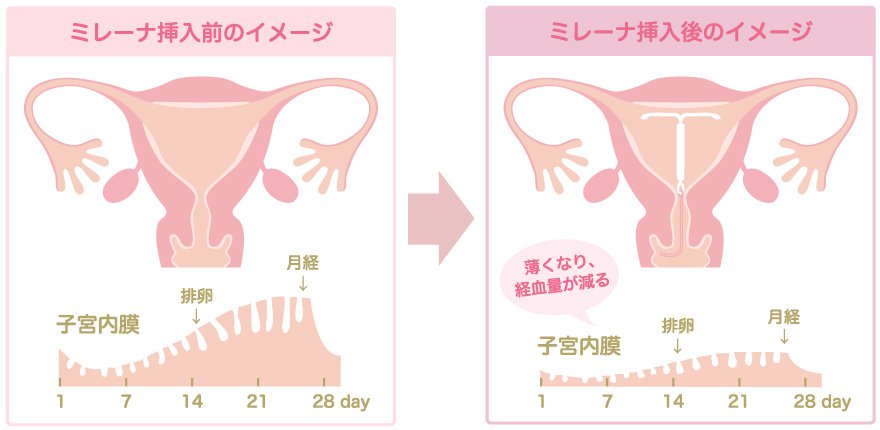 効果2：過多月経・月経困難症の症状緩和