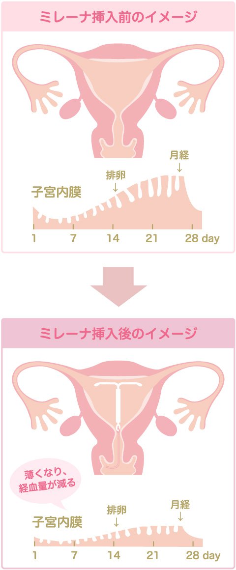 効果2：過多月経・月経困難症の症状緩和