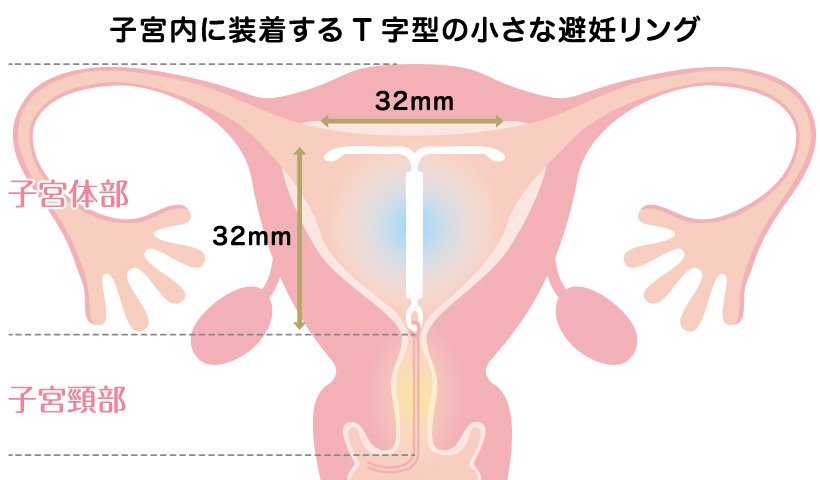子宮内避妊器具（ミレーナ）について | 札幌・石狩市の産婦人科「エナ