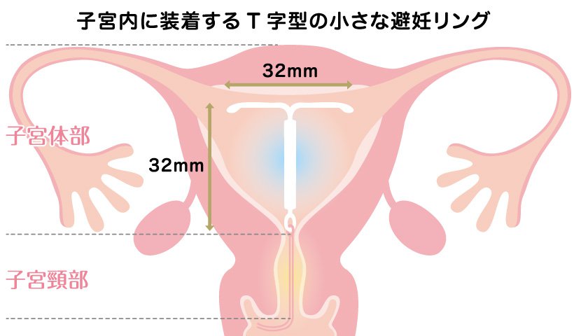 子宮内避妊器具 ミレーナ について 札幌 石狩市の産婦人科 エナレディースクリニック