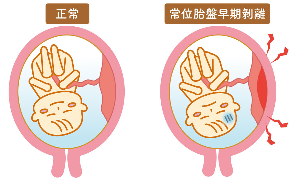 妊娠時の、正常な子宮内と常位胎盤早期剝離を発症した子宮内の比較