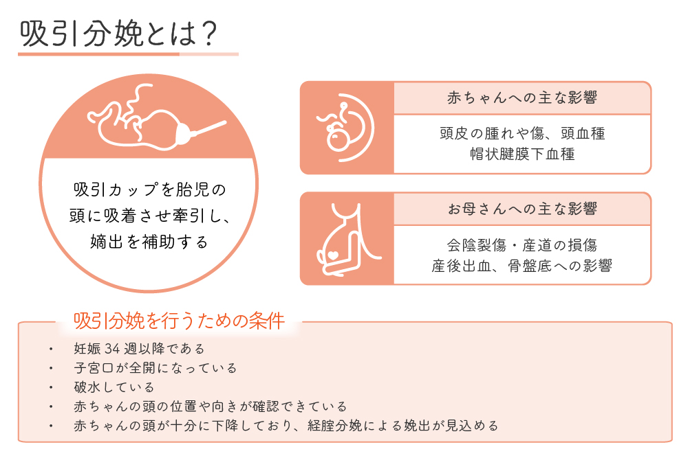 吸引分娩とは?